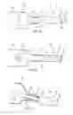Fig. 04 - Apparatus and methods for treating obstructions within body lumens