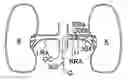 Fig. 01 - APPARATUSES FOR BILATERAL RENAL NEUROMODULATION
