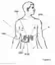Fig. 11 - APPARATUSES FOR BILATERAL RENAL NEUROMODULATION