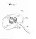 Fig. 17 - Universal catheter securement device