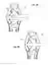 Fig. 19 - Universal catheter securement device