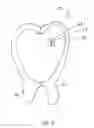 Fig. 04 - SACRAL WOUND DRESSING AND METHOD OF MANUFACTURING A WOUND THERAPY DEVICE