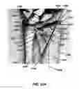 Fig. 26 - Intramedullary fixation assembly and method of use