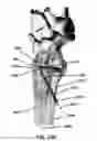 Fig. 29 - Intramedullary fixation assembly and method of use