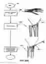 Fig. 30 - Intramedullary fixation assembly and method of use