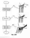 Fig. 31 - Intramedullary fixation assembly and method of use