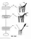 Fig. 32 - Intramedullary fixation assembly and method of use