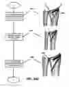 Fig. 33 - Intramedullary fixation assembly and method of use