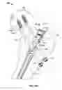 Fig. 25 - Lockable intramedullary fixation device