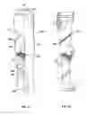 Fig. 26 - Lockable intramedullary fixation device