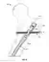 Fig. 33 - Lockable intramedullary fixation device