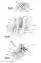 Fig. 04 - Bone fixation assembly