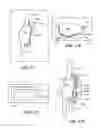 Fig. 33 - Joint arthroplasty devices and surgical tools