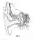 Fig. 02 - Instrument for Inserting Implantable Electrode Carrier
