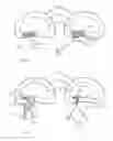 Fig. 17 - Methods for facilitating tissue puncture
