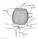 Fig. 01 - Multiple layer filamentary devices for treatment of vascular defects