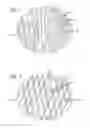 Fig. 07 - Multiple layer filamentary devices for treatment of vascular defects