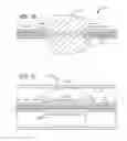Fig. 27 - Multiple layer filamentary devices for treatment of vascular defects