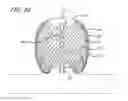 Fig. 33 - Multiple layer filamentary devices for treatment of vascular defects