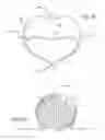 Fig. 42 - Multiple layer filamentary devices for treatment of vascular defects