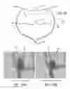 Fig. 43 - Multiple layer filamentary devices for treatment of vascular defects