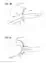 Fig. 45 - Multiple layer filamentary devices for treatment of vascular defects