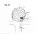 Fig. 47 - Multiple layer filamentary devices for treatment of vascular defects