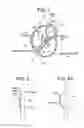 Fig. 02 - Patent foramen ovale closure method