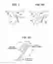 Fig. 03 - Patent foramen ovale closure method