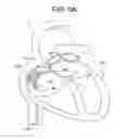 Fig. 16 - Patent foramen ovale closure method