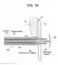 Fig. 28 - Patent foramen ovale closure method