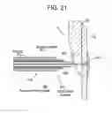 Fig. 30 - Patent foramen ovale closure method