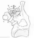 Fig. 01 - Vertebral fixing system