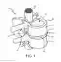 Fig. 02 - SPINE SURGERY METHOD AND IMPLANT DEPLOYMENT