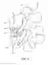 Fig. 03 - SPINE SURGERY METHOD AND IMPLANT DEPLOYMENT