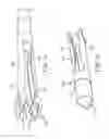 Fig. 10 - SPINE SURGERY METHOD AND IMPLANT DEPLOYMENT