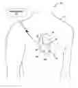 Fig. 01 - Disabling an implanted medical device with another medical device