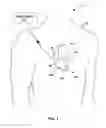 Fig. 02 - Disabling an implanted medical device with another medical device