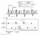 Fig. 01 - Methods and devices for accurately classifying cardiac activity