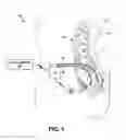Fig. 02 - Bilateral electrical stimulation therapy for bladder dysfunction