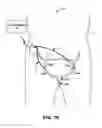 Fig. 16 - Bilateral electrical stimulation therapy for bladder dysfunction