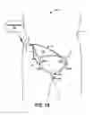 Fig. 16 - Stimulation therapy including substantially simultaneous bilateral stimulation