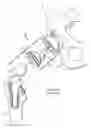 Fig. 02 - Electrosurgical system and method for treating hard body tissue
