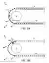 Fig. 04 - Percutaneous placement of electrodes