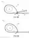 Fig. 05 - Percutaneous placement of electrodes