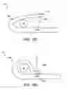 Fig. 11 - Percutaneous placement of electrodes