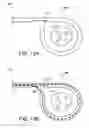 Fig. 17 - Percutaneous placement of electrodes