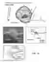 Fig. 23 - Percutaneous placement of electrodes