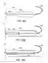 Fig. 35 - Percutaneous placement of electrodes