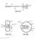 Fig. 49 - BALLOON CATHETER WITH INTEGRATED STOP FEATURE FOR PRECISE STENT PLACEMENT, FOR OSTIAL, RENAL AND OTHER LOCATIONS